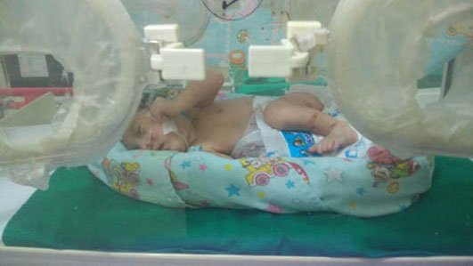 Seorang Bayi di Tembilahan dengan Usus di Luar Tubuh