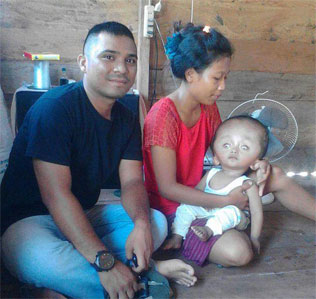 Dy Aheng, Balita Penderita Hydrocephalus Butuh Pertolongan