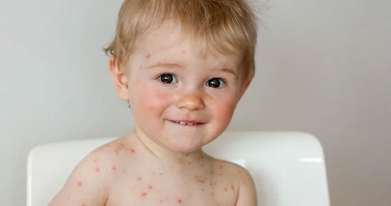 Ruam pada Anak - Pengobatan Ruam akibat Virus Cacar Air