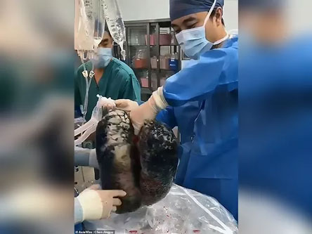 Paru-Paru Hitam Akibat Merokok 30 Tahun Viral