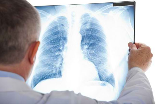 Mengenal Macam-Macam Pneumonia