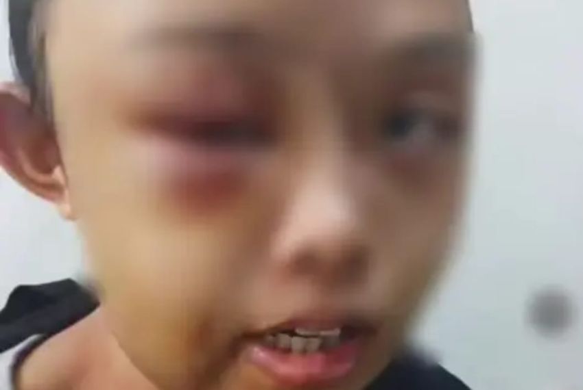 Gadis Yatim Piatu di Tarai Bangun Dianiaya Tante Hingga Lebam